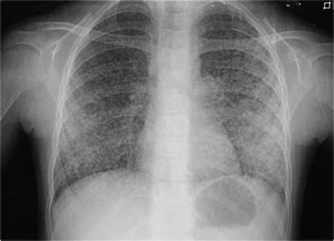 953 Miliary Tuberculosis In An Immunocompetent Child Archives Of