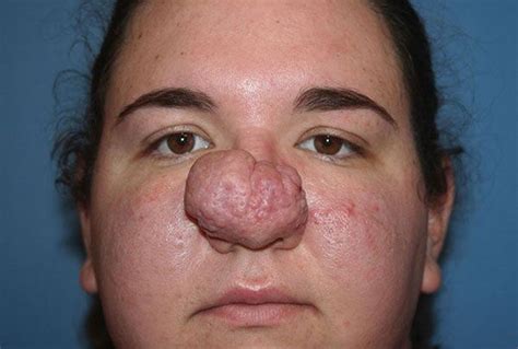 Diagnosed With Rhinophyma Sarah Underwent A Surgery To Correct Her