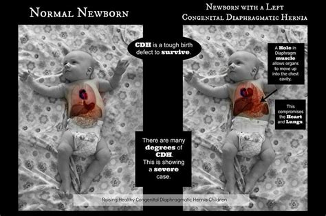 Normal Newborn Versus A Newborn Born With Left Congenital Diaphragmatic