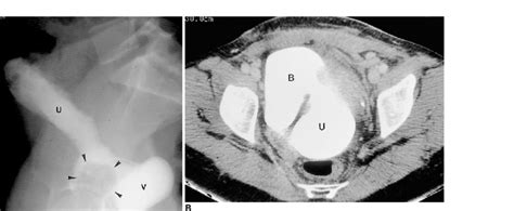 Vesicouterine Fistula In A Patient With Urinary Incontinence And
