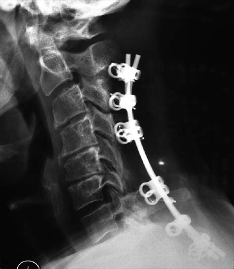 Nursing Review Of Cervical Laminectomy And Fusion Surgical Neurology