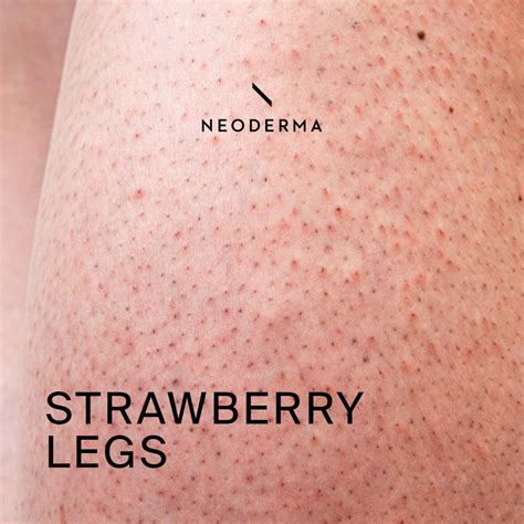 Strawberry Legs Treatment Neoderma