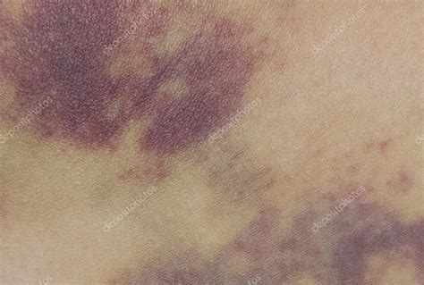 Closeup On A Bruise On Wounded Woman Leg Skin — Stock Photo