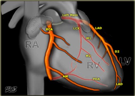 Analysis of 207 cadaver coronary arteries showed left coronary artery (lca) dominance type was present in 6.3% of there were also differences in the number of diagonal arteries in the dissected samples. Ramus intermedius coronary artery anatomy | Coronary ...