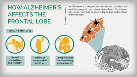 Frontal Lobe Dementia Stages Check More At