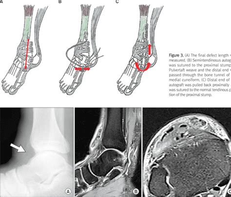 Figure 2 From Chronic Tibialis Anterior Tendon Rupture Treated With