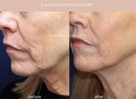 profound treatment skin tightening treatment