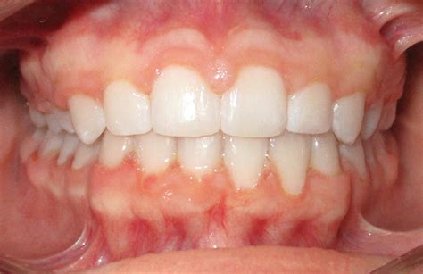 Check spelling or type a new query. Cross Bite Before and After Braces Pictures | McCormick ...