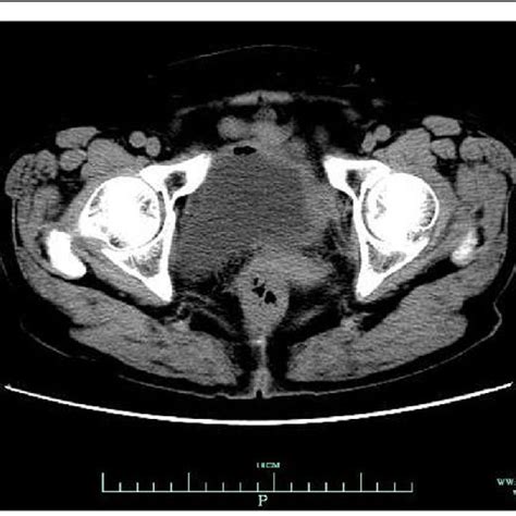 A The Sigmoid Colon Was Perforated And Fixed To The Left Abdominal Wall