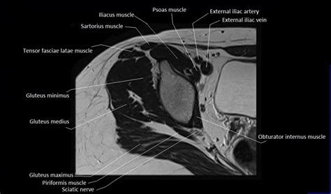 Mri Anatomy Of Hip Joint Free Mri Axial Hip Anatomy