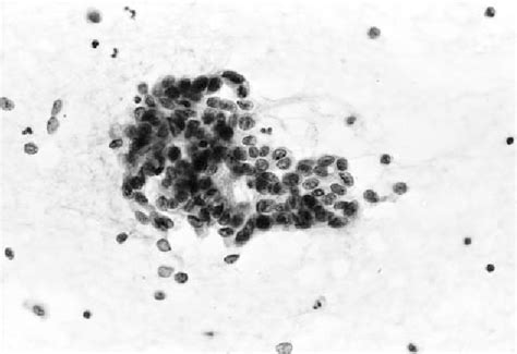 Figure 1 From Cytomorphologic Features Of A Polymorphous Low Grade