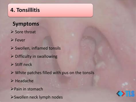 Ppt Causes Of White Spots On Tonsils You May Not Know Powerpoint