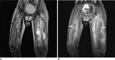 Follow Up Mr Images Of Both Thighsa A Coronal T2 Weig Open I