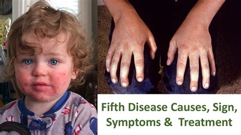 What Is Fifth Disease Fifth Disease Causes Sign Symptoms Treatment