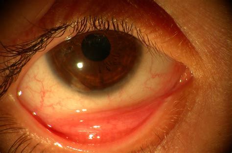 Vernal Keratoconjunctivitis Vkc Ocular