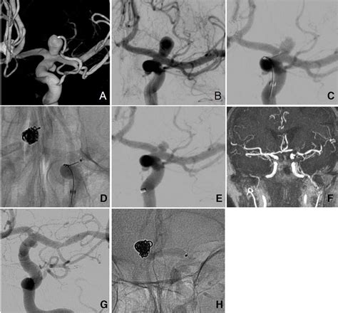 Endovascular treatment of wide-necked intracranial aneurysms using the novel Contour 