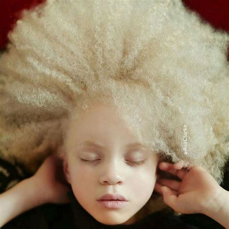 Ava Clarke Beauty People Albinism Albino Girl