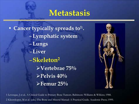 Ppt Metastatic Bone Disease And Multiple Myeloma Powerpoint