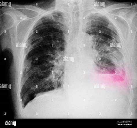 Chest X Ray Showing Lung Cancer And Infiltrates Stock Photo Alamy