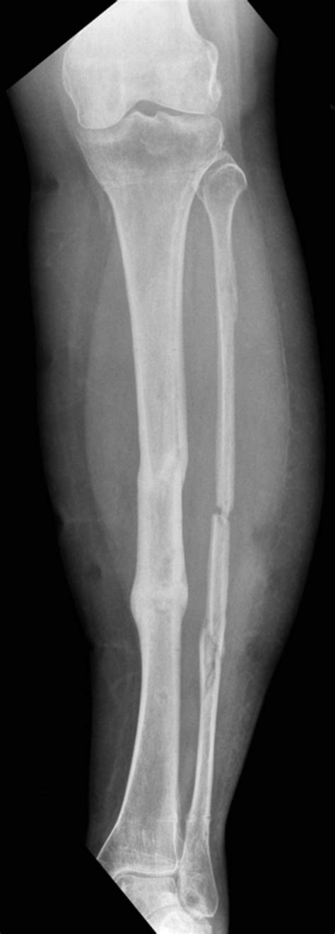 The Treatment Of Complex Tibial Shaft Fractures By The Ilizarov Method