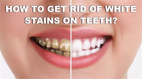 You've been told you can scare them away, but how can you really get rid of them? How To Get Rid of White Stains on Teeth with Home Remedies ...