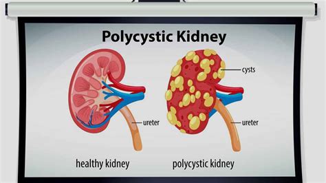 Polycystic Kidney Disease Causes And Symptoms Onlymyhealth