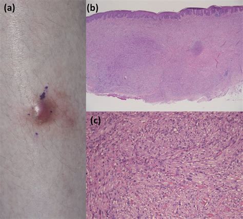 A Clinical Picture Of The Erythematous Subcutaneous Nodule On The