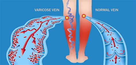 Varicose Veins Vs Spider Veins What You Need To Know Beaumont