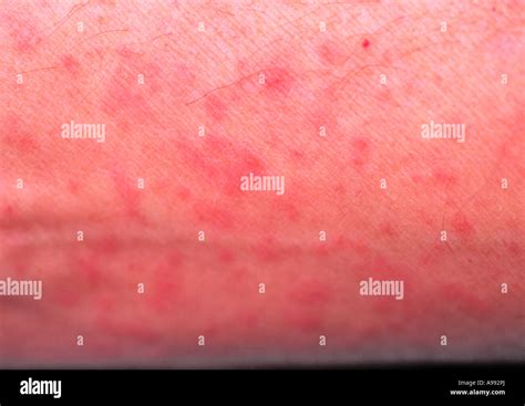 Heat Rash Hi Res Stock Photography And Images Alamy