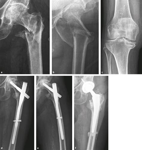 4 8 Fragility Fractures And Orthogeriatric Care Musculoskeletal Key