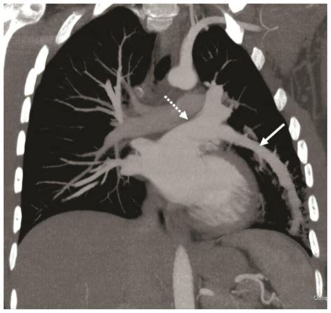 A Complex Pulmonary Vein Varix Diagnosis With Ecg Gated Mdct Mri