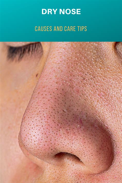 Dry Nose Causes And Care Tips Dry Nose Dry Nose Remedy Dry Nose Skin