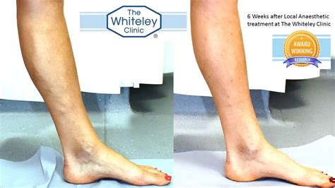 Varicose Veins Before And After The Whiteley Clinic