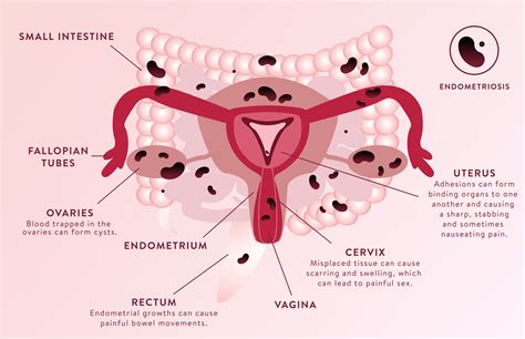 This Is What Endometriosis Does To Your Body