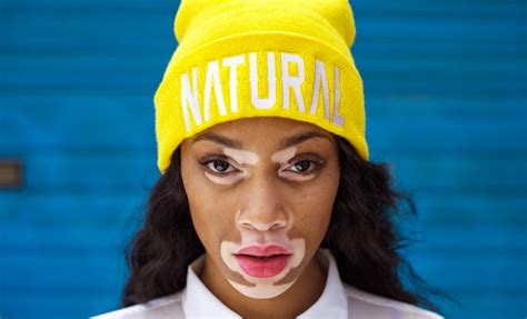 This Model With A Skin Condition Is Challenging The Notion That