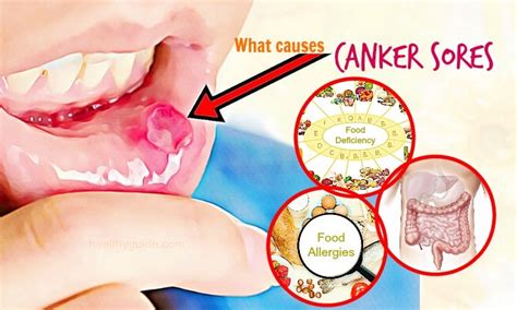 What Causes Canker Sores On Gum And In The Throat Top 17 Causes