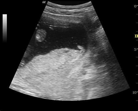 Circumvallate Placenta Will Demonstrate A Raised Pl Edge On Us