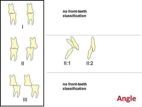 The Bite Type Malocclusion Classification An Extended Angle Method