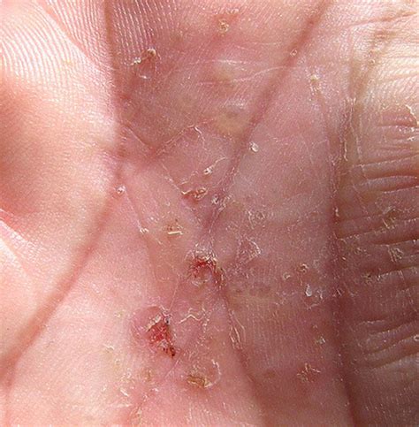 Dyshidrotic Eczema Pictures