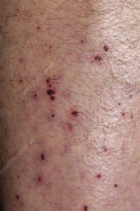 Scratch Marks Due To Eczema Stock Image C0042406 Science Photo