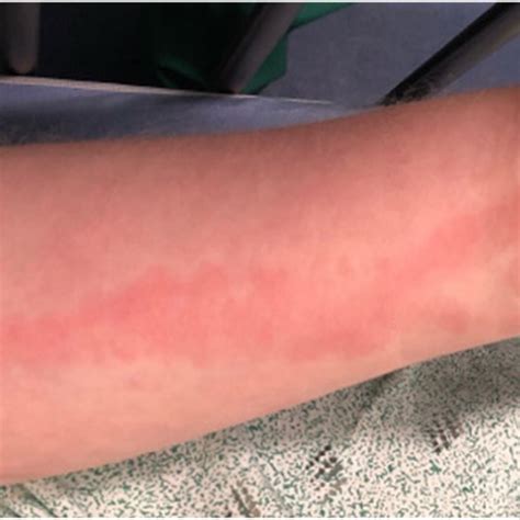 Pdf Case Report Palmar Herpetic Whitlow And Forearm Lymphangitis In