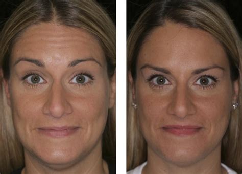 A brow lift can raise the eyebrows and restore a refreshed, more pleasing appearance. Botox | Dysport Injections | Before And After | Fort ...