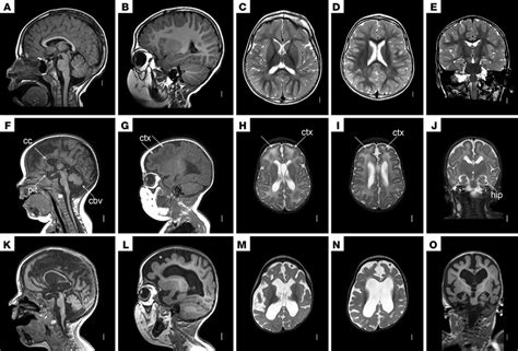 Mri Scan Images Of Patient Nm720 Brain Mri In A Normal 3 Year Old