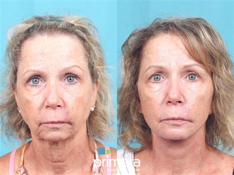 Mini Facelift Before And After Pictures Case 791 Orlando Florida Primera Plastic Surgery