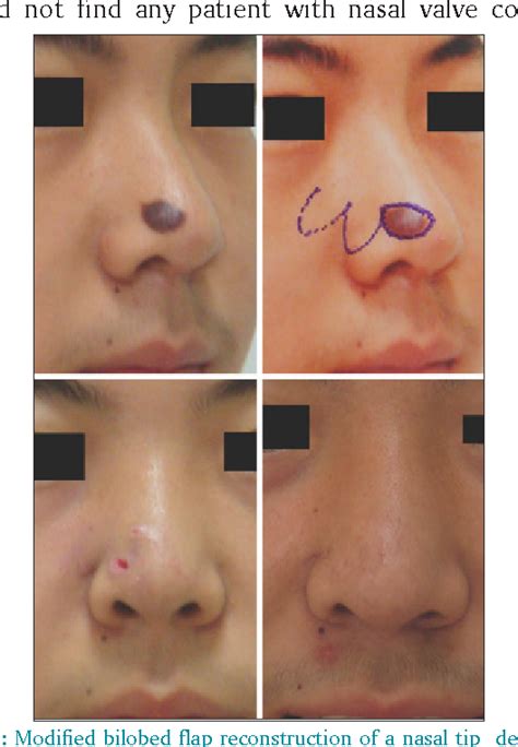 Figure From A Modified Bilobed Flap Design For Nasal Tip Defects