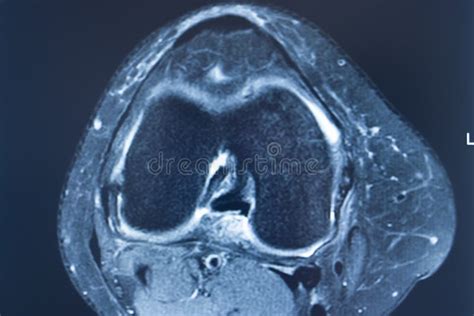Knee Injury Mri Mcl Tear Stock Photo Image Of Diagnosis 172886114