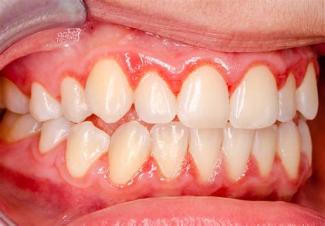 What Do Healthy Gums Look Like Pictures And Action Plan