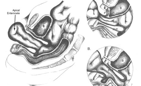 laparoscopic vaginal vault suspension using uterosacral ligaments a review of 133 cases theme