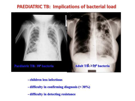 Ppt Paediatric Tuberculosis Powerpoint Presentation Free Download