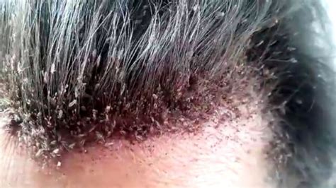 Head Lice Infestation Symptoms Causes And Risk Factors